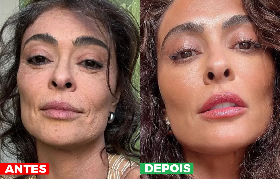 Antes e Depois do uso do PDRN