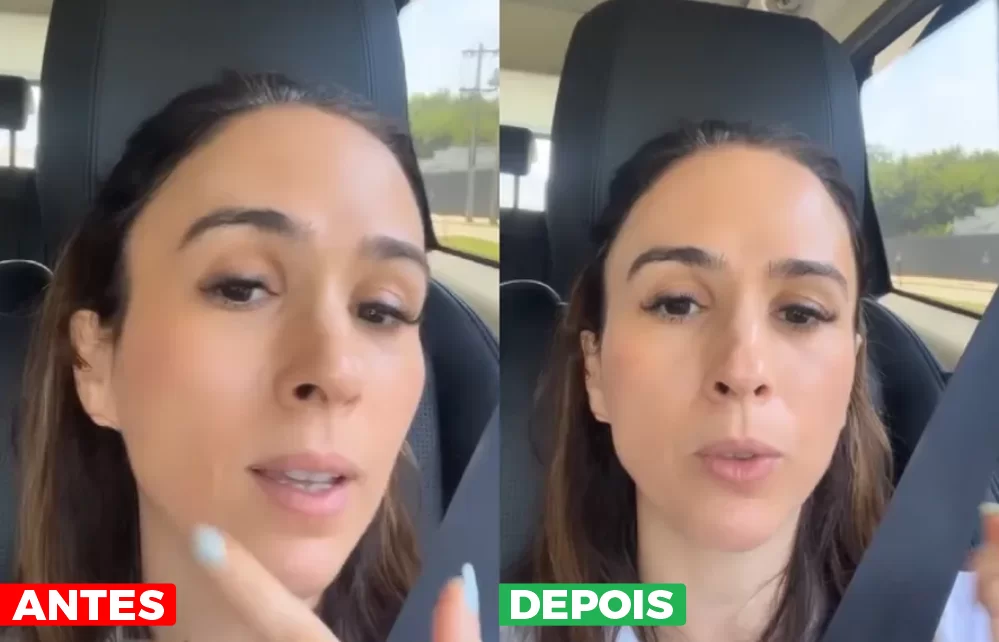 Resultado famoso com PDRN